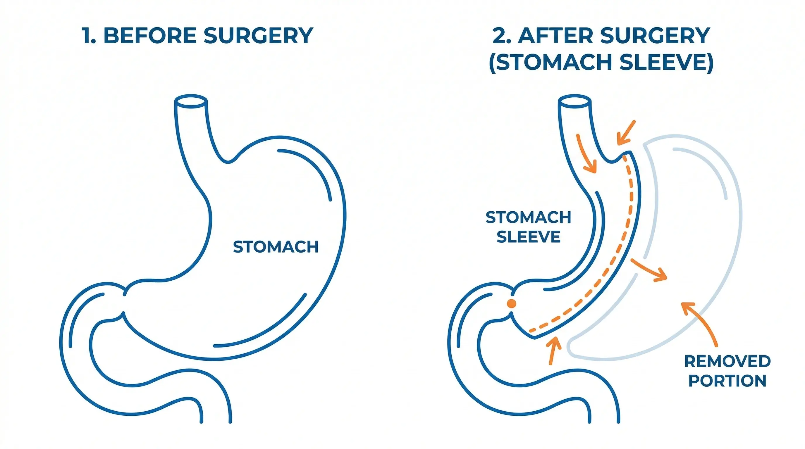 Weight loss surgery