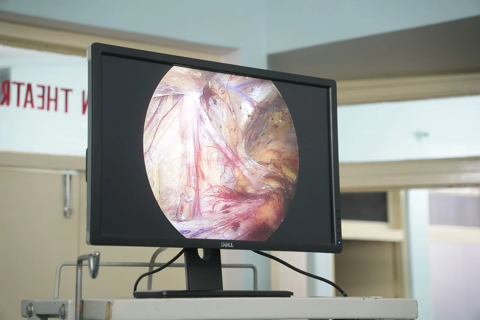 Endoscopic monitor during procedure